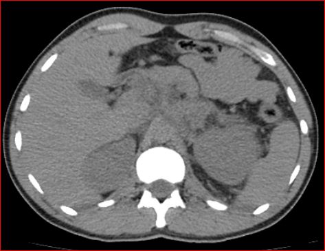 File:Burned-out testicular choriocarcinoma (Radiopaedia 32822-34040 Axial non-contrast 3).jpg