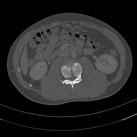 Burst fracture with cauda equina syndrome (Radiopaedia 25701-25867 Axial bone window 55).jpg