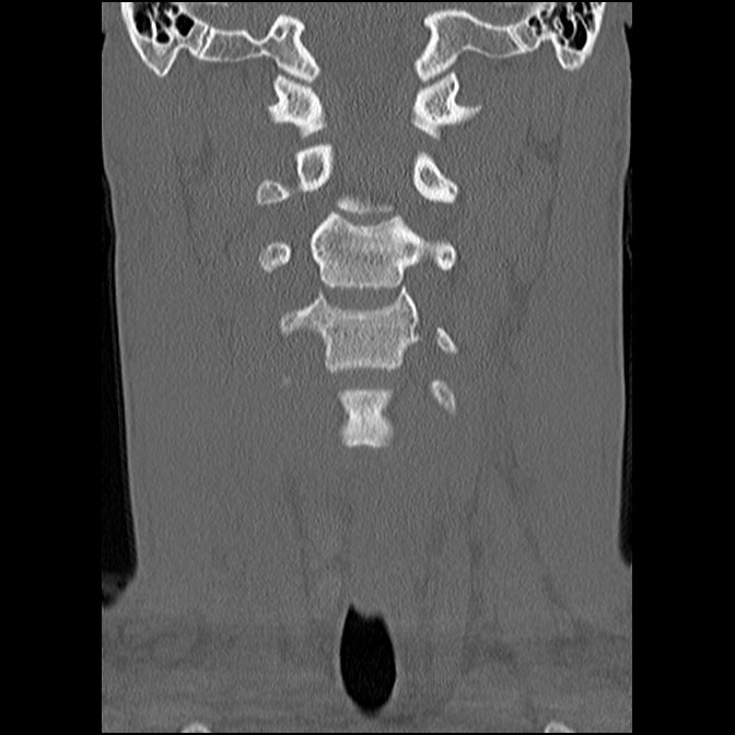 C5 facet fracture (Radiopaedia 58374-65499 Coronal bone window 25).jpg