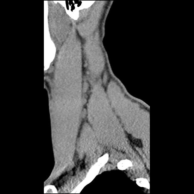 C5 facet fracture (Radiopaedia 58374-65499 D 11).jpg