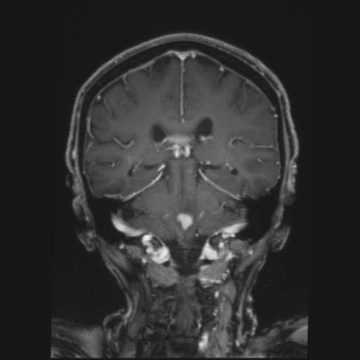 File:CNS lymphoma with steroid response (Radiopaedia 37980-39921 Coronal T1 C+ 29).png