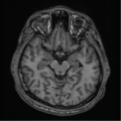 CNS vasculitis (Radiopaedia 55715-62263 Axial T1 12).png