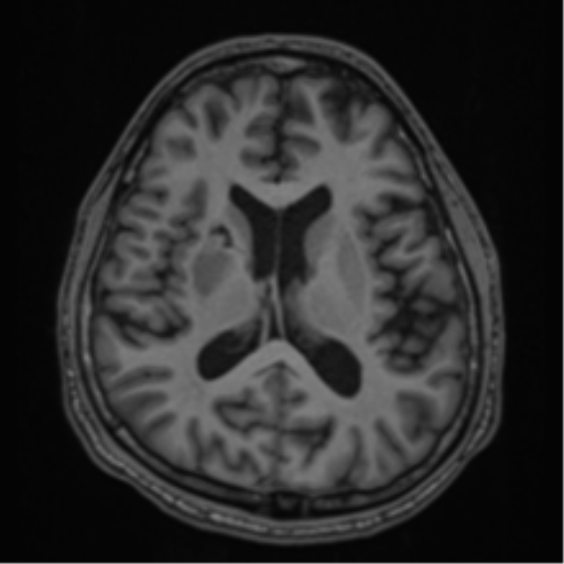 CNS vasculitis (Radiopaedia 55715-62263 Axial T1 40).png