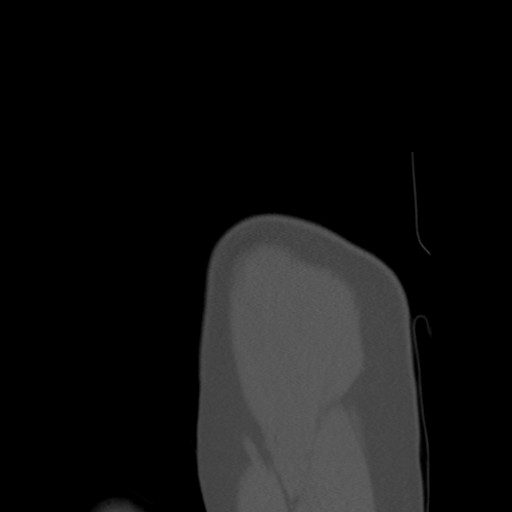 File:Calcific tendinitis of the infraspinatus tendon (Radiopaedia 87256-103539 Sagittal bone window 11).jpg