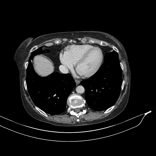 Calcified adrenal glands and Spigelian hernia (Radiopaedia 49741-54988 A 11).jpg