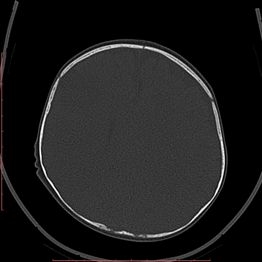 Calcified middle cerebral artery embolism (Radiopaedia 78949-91860 Axial bone window 46).jpg