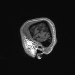Callosal dysgenesis with interhemispheric cyst (Radiopaedia 53355-59335 Sagittal T1 162).jpg
