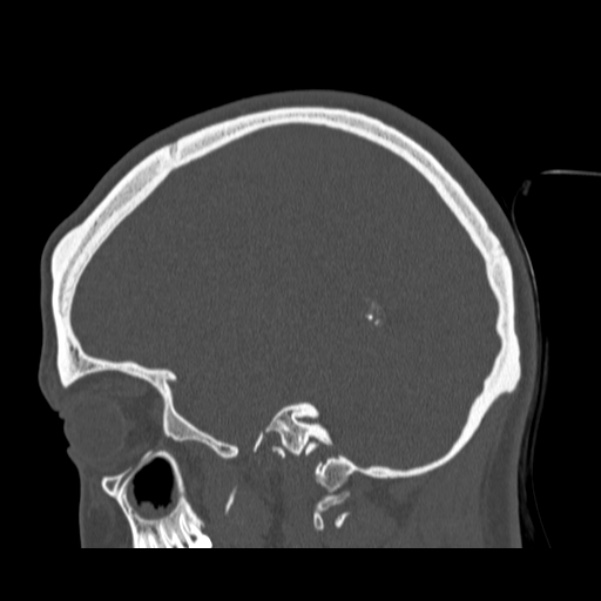 Calvarial osteoma (Radiopaedia 36520-38079 Sagittal bone window 38).jpg