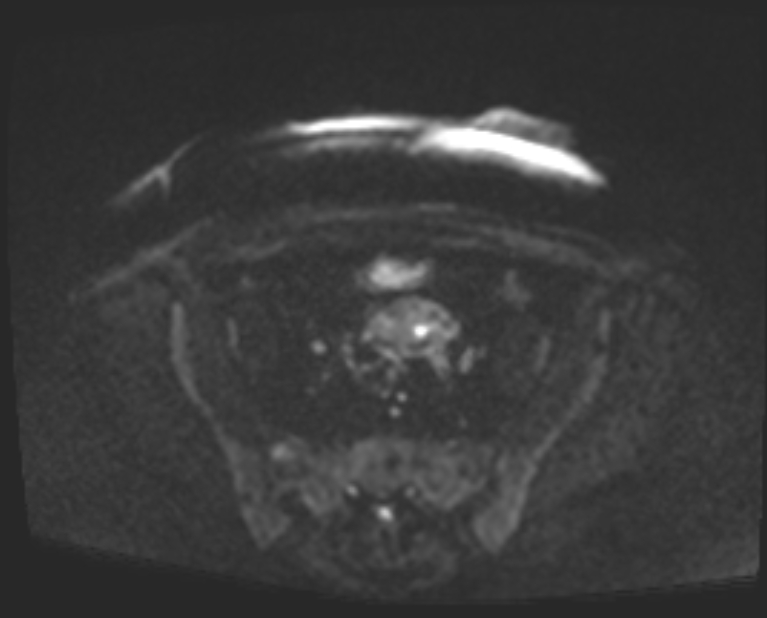 Cancer cervix - stage IIb (Radiopaedia 75411-86615 Axial DWI 52).jpg