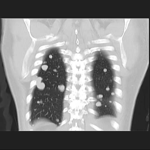 File:Cannonball pulmonary metastases (Radiopaedia 67684-77101 C 22).jpg