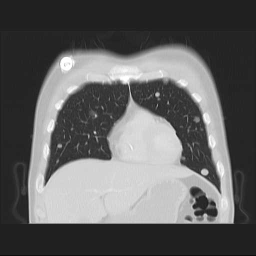 File:Cannonball pulmonary metastases (Radiopaedia 67684-77101 C 5).jpg