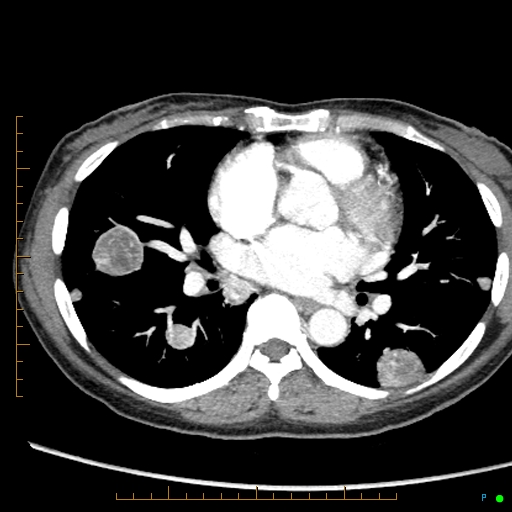 Canonball lung metastasis (Radiopaedia 77634-89837 B 53).jpg
