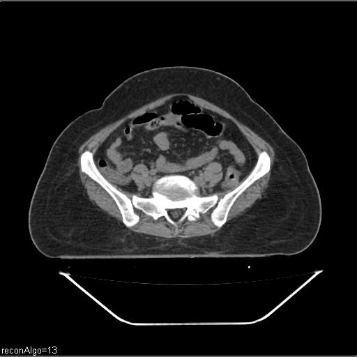 Carcinoma cervix- brachytherapy applicator (Radiopaedia 33135-34173 Axial non-contrast 5).jpg