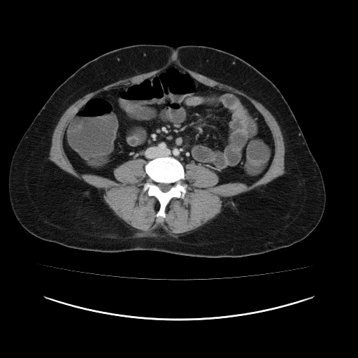 Carcinoma colon - hepatic flexure (Radiopaedia 19461-19493 A 77).jpg