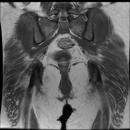 File:Carcinoma of the cervix (Radiopaedia 89018-105858 Coronal T1 13).jpg
