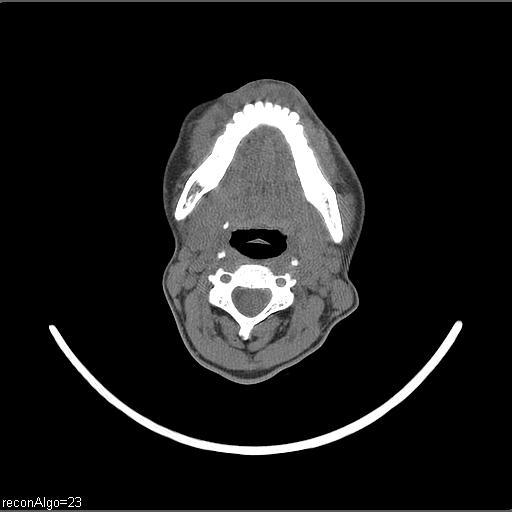 Carcinoma of the maxillary antrum (Radiopaedia 53805-59888 Axial non-contrast 40).jpg