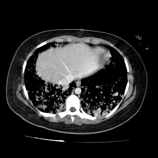 File:Cardiac angiosarcoma (Radiopaedia 66010-75181 B 75).jpg