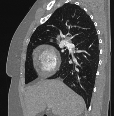 Cardiac sarcoidosis (Radiopaedia 74548-85534 Sagittal lung window 61).jpg