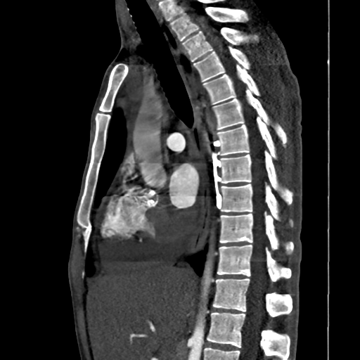 File:Cardiac tumor - undifferentiated pleomorphic sarcoma (Radiopaedia 45844-50134 B 40).png