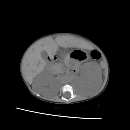 File:Caroli disease with autosomal recessive polycystic kidney disease (ARPKD) (Radiopaedia 89651-106703 Axial non-contrast 26).jpg