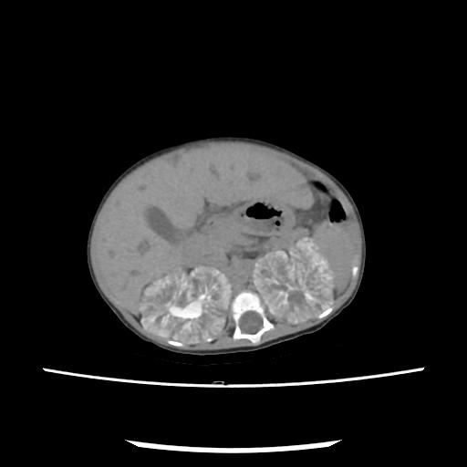 Caroli disease with autosomal recessive polycystic kidney disease (ARPKD) (Radiopaedia 89651-106703 E 89).jpg