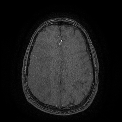 Carotid arterial dissection with acute cerebral infarction (Radiopaedia 26636-26784 MRA 38).jpg