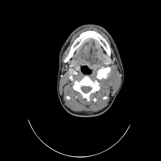 File:Carotid bulb pseudoaneurysm (Radiopaedia 57670-64616 A 29).jpg