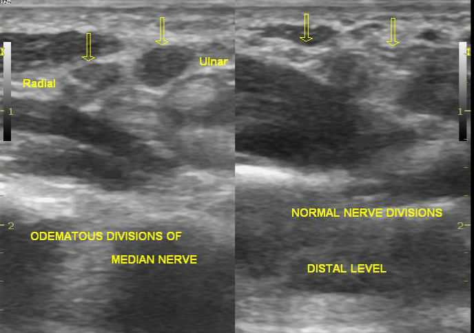 File:Carpal tunnel syndrome - with inverted notch sign (Radiopaedia 25567-25760 E 1).jpg