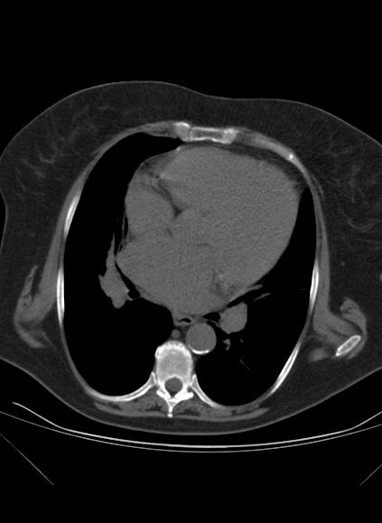 File:Caseous mitral annular calcification (Radiopaedia 61219-69122 Axial non-contrast 5).jpg
