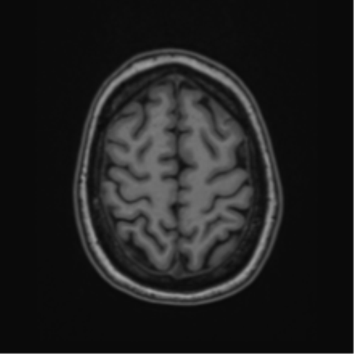 Cavernoma with bleed - midbrain (Radiopaedia 54546-60774 Axial T1 46).png