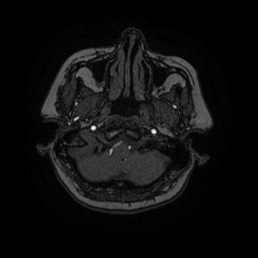 File:Cavernoma with developmental venous anomaly (Radiopaedia 22470-22507 MRA 92).jpg