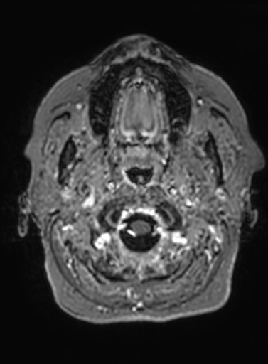 Cavernous hemangioma of the cerebellar falx (Radiopaedia 73025-83724 Axial T1 C+ 329).jpg