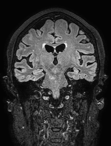 Cavernous hemangioma of the cerebellar falx (Radiopaedia 73025-83724 Coronal FLAIR 189).jpg