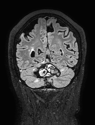 Cavernous hemangioma of the cerebellar falx (Radiopaedia 73025-83724 Coronal FLAIR 270).jpg