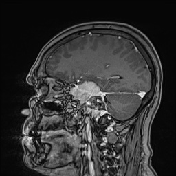 Cavernous sinus meningioma (Radiopaedia 63682-72367 Sagittal T1 C+ 66).jpg