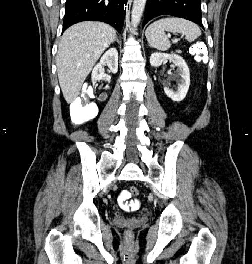 Cecal adenocarcinoma (Radiopaedia 85324-100916 D 46).jpg