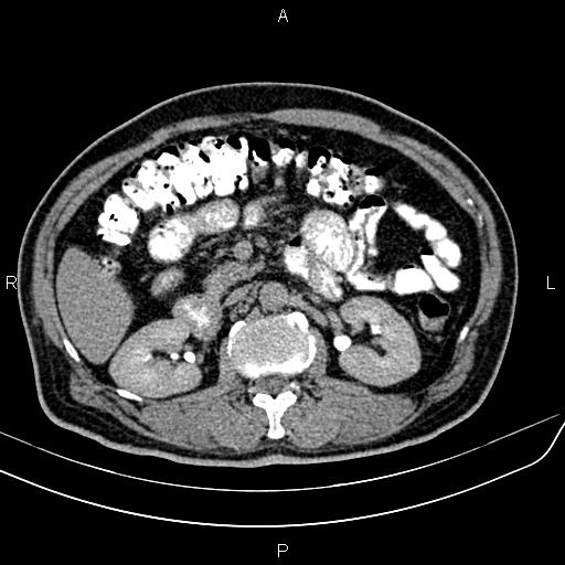File:Cecal cancer with appendiceal mucocele (Radiopaedia 91080-108651 Axial C+ delayed 22).jpg