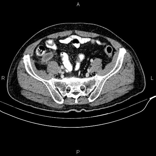 File:Cecal cancer with appendiceal mucocele (Radiopaedia 91080-108651 B 81).jpg