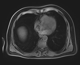 Cecal mass causing appendicitis (Radiopaedia 59207-66532 Axial T1 12).jpg