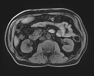 Cecal mass causing appendicitis (Radiopaedia 59207-66532 Axial T1 61).jpg