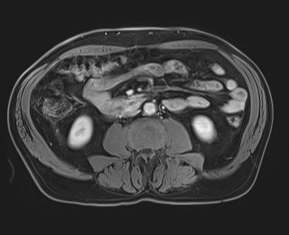 Cecal mass causing appendicitis (Radiopaedia 59207-66532 T1 C+ PV phase 75).jpg