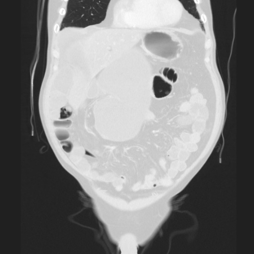 Cecal volvulus (Radiopaedia 75378-86620 Coronal lung window 50).jpg