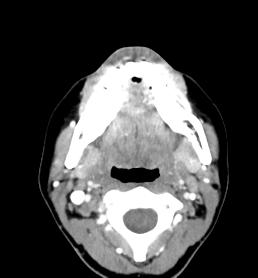 File:Cemento-ossifying fibroma (Radiopaedia 46243-50643 Axial C+ delayed 39).png