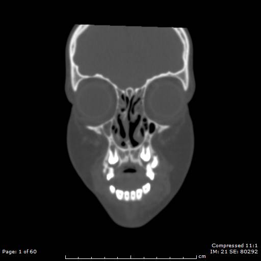 Central giant cell granuloma (Radiopaedia 45612-49754 Coronal bone window 1).jpg