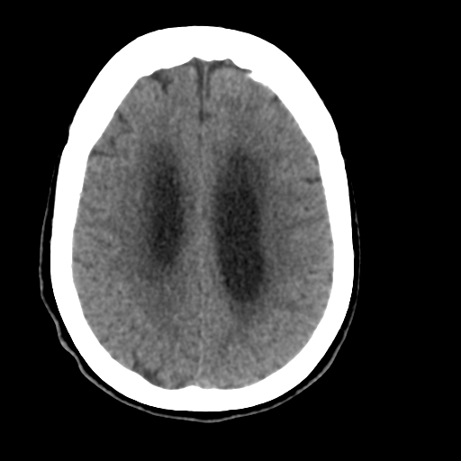 Central neurocytoma (Radiopaedia 65317-74346 Axial non-contrast 35).png