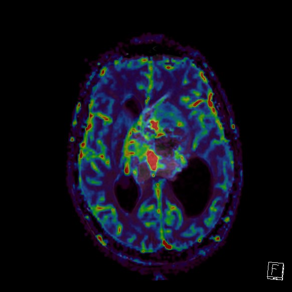 Central neurocytoma (Radiopaedia 84497-99872 Axial Perfusion 149).jpg