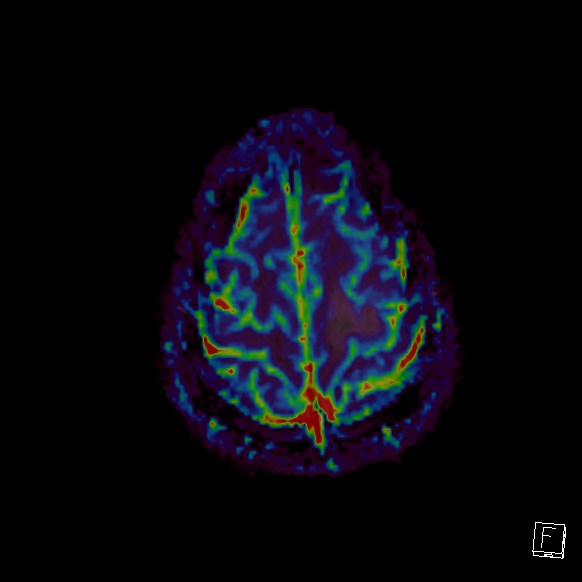 File:Central neurocytoma (Radiopaedia 84497-99872 Axial Perfusion 39).jpg