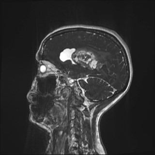 Central neurocytoma (Radiopaedia 84497-99872 Sagittal CISS 24).jpg