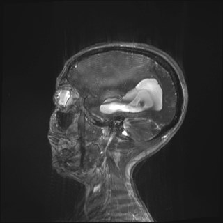 Central neurocytoma (Radiopaedia 84497-99872 Sagittal CISS 87).jpg