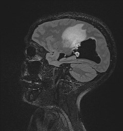 File:Central neurocytoma (Radiopaedia 84497-99872 Sagittal Flair + Gd 104).jpg